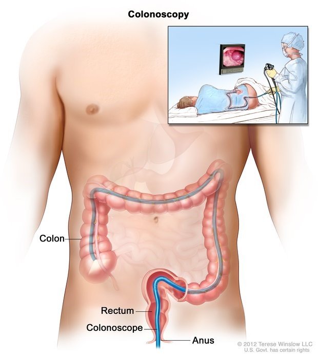 colonoscopy