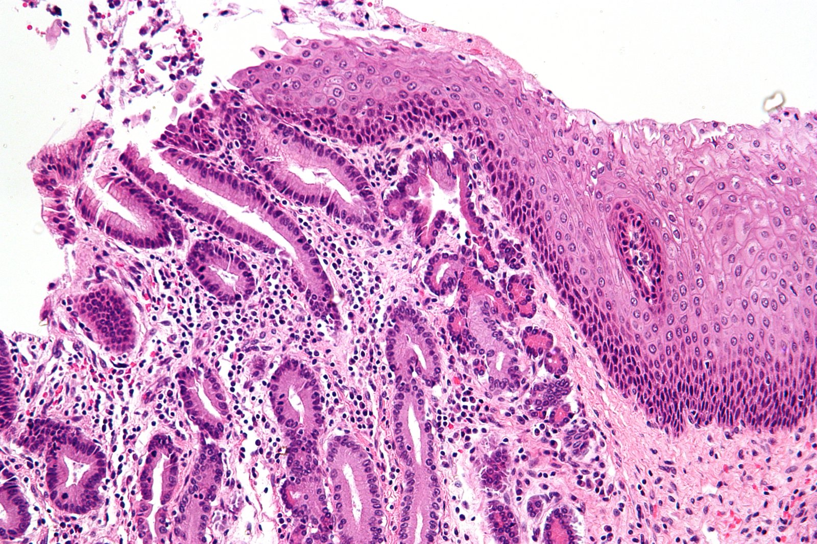 sgc-metaplasia